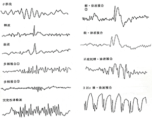 てんかん性脳波には、棘波・鋭波・棘徐波複合体等の突発性異常波があります。 異常波の間欠期には、不規則な徐波が存在し、背景脳波が乱れています。