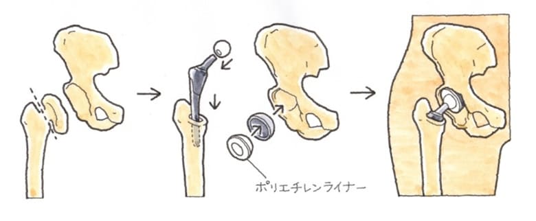 下肢の関節に人工骨頭や人工関節が置換されたとき