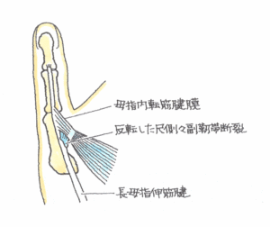 反転した尺側々副靭帯