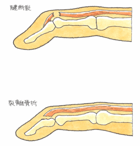 腱断裂