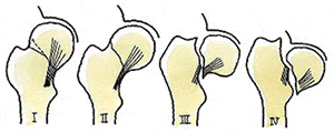大腿骨頚部の骨折分類