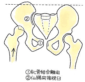 仙腸関節が脱臼し、恥骨結合が離開、右股関節は、大腿骨頭が後方脱臼