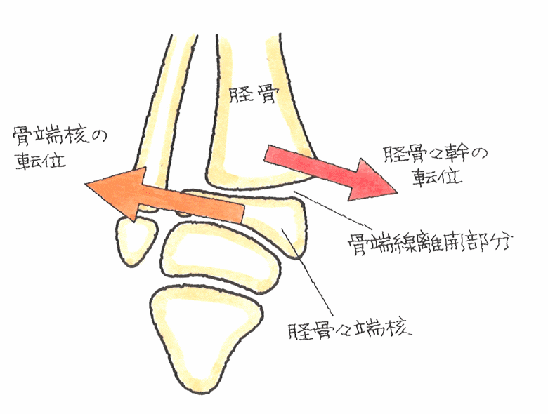脛骨の骨端線を横断するように骨端線が離開したもの