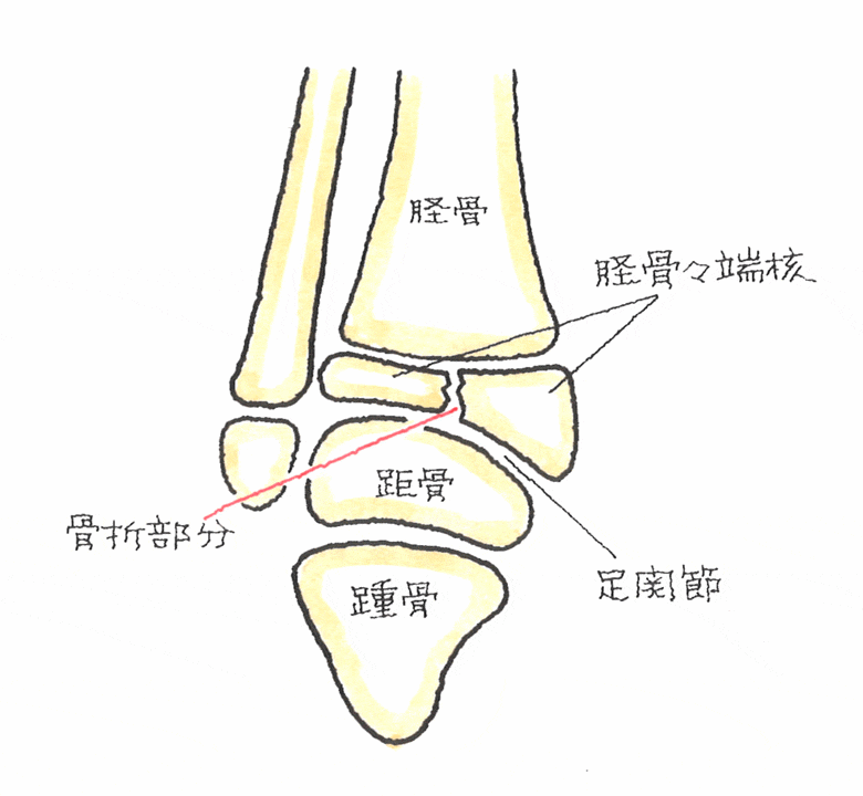 脛骨に上方から外力が作用したとき、足関節の強い捻挫で脛骨々端核が垂直や斜め骨折