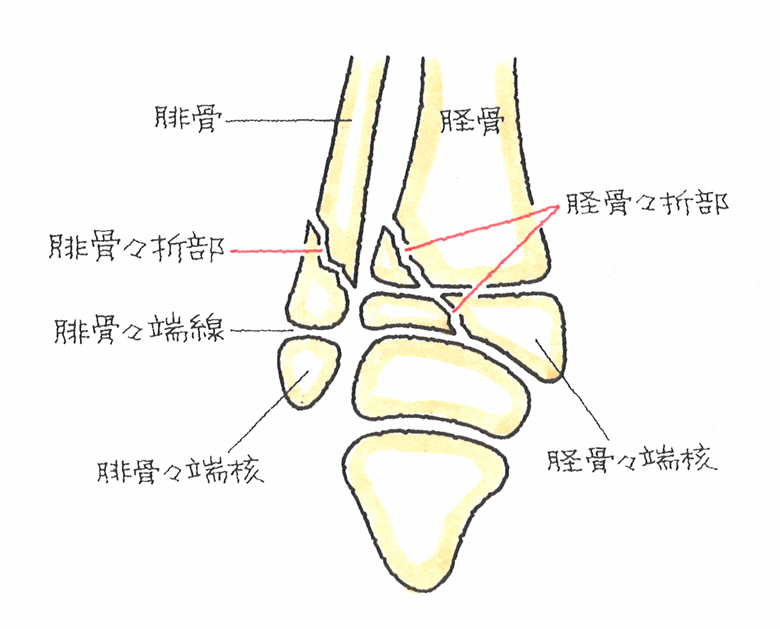脛骨々端の斜骨折、腓骨の斜骨折