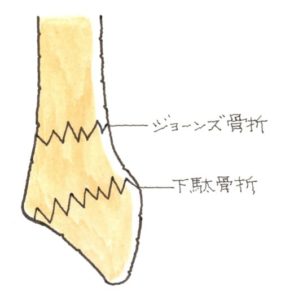 中足骨の骨折