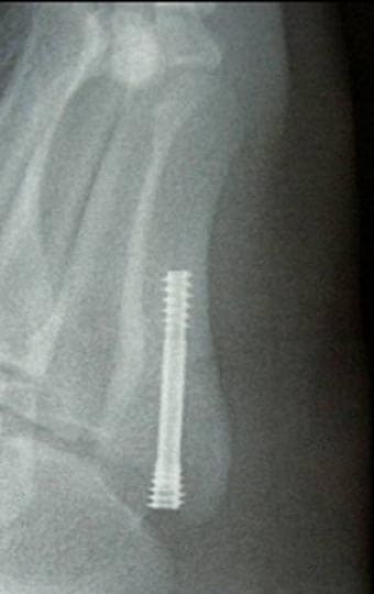 第5中足骨々幹端部骨折のレントゲン画像