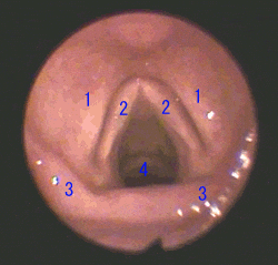 ファイバースコープで見た正常の喉頭で、1が仮声帯、2が声帯で、左右一対です。