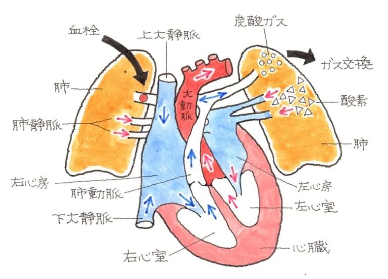 肺塞栓症における喀血の原因は何ですか?