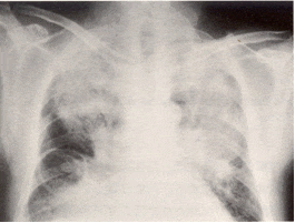 脂肪塞栓症候群の原因